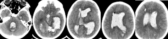 Рисунок 2.КТ исследование головного мозга пациентки после интраоперационного разрыва артерио-венозной мальформации левой теменно-височной области (наблюдение 2).