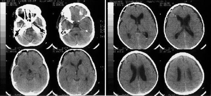 Рисунок 2. Компьютерная томография головного мозга в 4 сутки после операции. Выявляется равномерное скопление ликвора субдурально с обеих сторон, уменьшение размеров желудочковой системы мозга по сравнению с 1 сутками после операции.