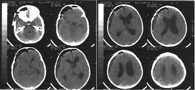 Рисунок 1. Компьютерная томография головного мозга в 1 сутки после операции. Выявляется скопление воздуха и ликвора в субдуральном пространстве, преимущественно справа. Правый боковой желудочек мозга компремирован.