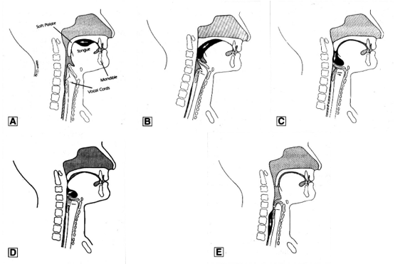 Рисунок 1. 5 фаз акта глотания.A, B, C – закрытие голосовой щели и сокращение истинных и ложных
голосовых складок, D, E – закрытие гортани надгортанником.