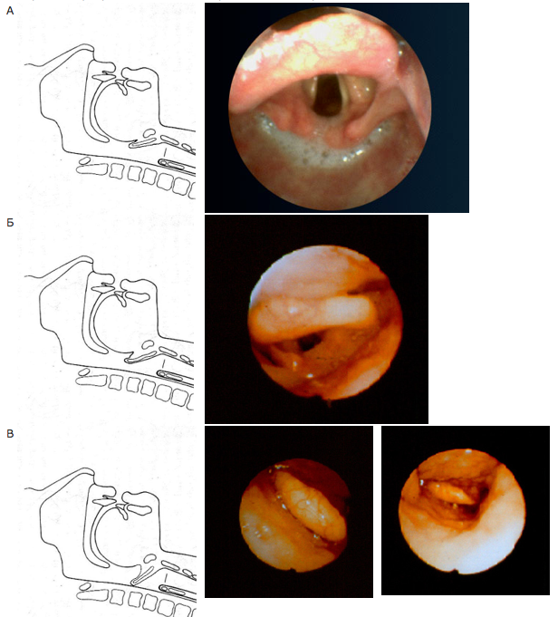 Рисунок 3. Варианты положения паретичного надгортанника. А – верхнее положение надгортанника, Б – среднее положение надгортанника, В – нижнее положение надгортанника