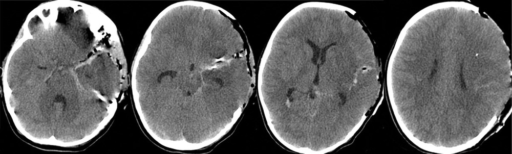 Рис. 2. Пациентка Э., 8 лет. КТ головного мозга (1-е сутки после операции). Сохраняется диффузный отек головного мозга.