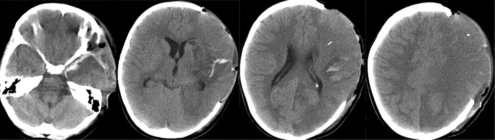 Рис. 3. Пациентка Э., 8 лет. КТ головного мозга (3-и сутки после операции). Отек и формирование очага ишемии в левом полушарии головного мозга, со значительным пролабированием ткани мозга в трепанационный дефект.