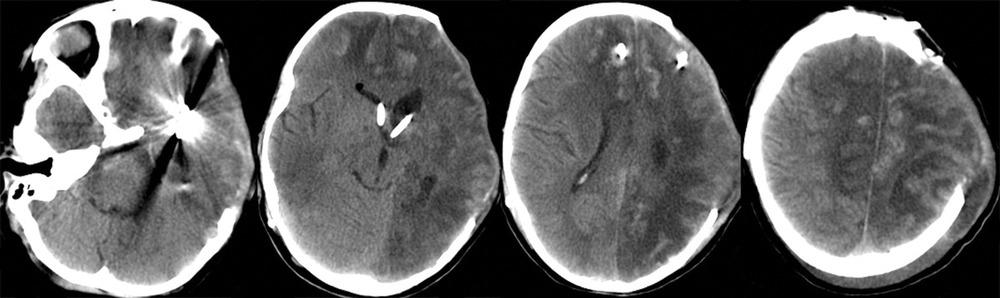 Рис. 5. Пациентка Э., 8 лет. КТ головного мозга (28-е сутки после операции). Постишемические нарушения в левом полушарии головного мозга и в бассейне передней мозговой артерии справа. Состояние после ВПШ.