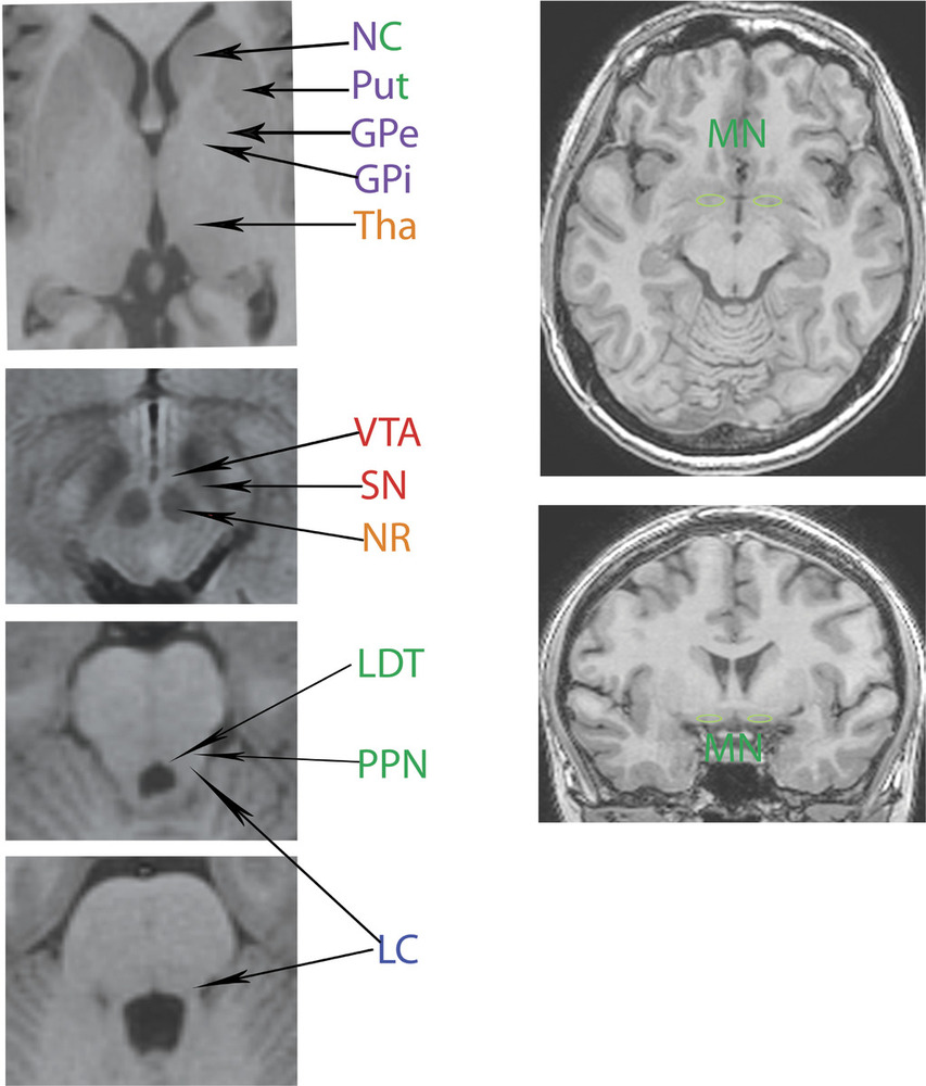 Рис. 1. Расположение структур мозга, включенных в факторный анализ. NC — хвостатое ядро, Put — скорлупа, GPi — внутренний сегмент бледного шара, GPe — наружный сегмент бледного шара, Tha — таламус, SN — черная субстанция, VTA — вентральная покрышечная область, MN — ядро Мейнерта, LDT — латеродорзальное ядро покрышки, PPN — педункулопонтийное ядро, NR — красное ядро, LC — голубоватое место. Красным цветом выделены дофаминергические, синим — норадренергические, зеленым — холинергические, оранжевым — глутаматергические, фиолетовым — ГАМКергические структуры мозга.