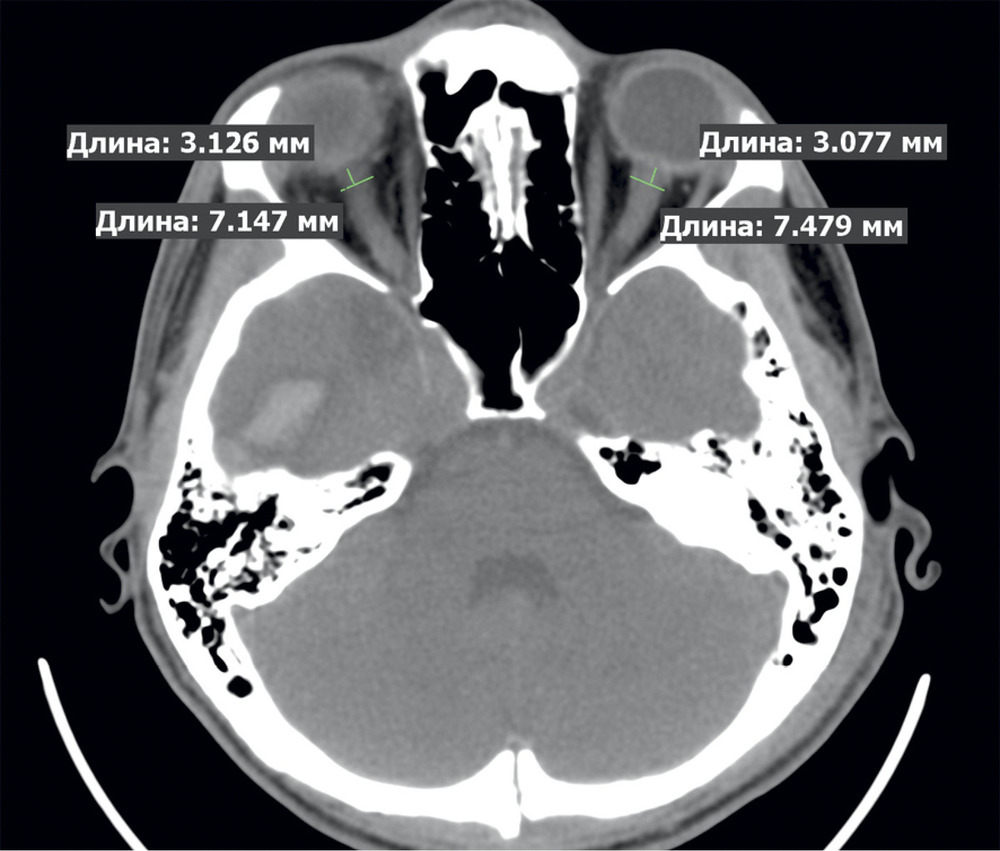 Рис. 2. КТ пациента с тяжелой ЧМТ и внутричерепной гипертензией. ДОЗН слева — 7,48 мм, справа — 7,15 мм. Внутримозговая гематома в базальных отделах правой височной доли.
