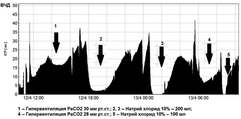 Рис. 3. Динамика ВЧД пациента после выполнения КТ (см. рис. 2) и принятия решения об инвазивном мониторинге ВЧД (представлены первые 24 ч). ВЧД на момент установки датчика — 5—6 мм рт.ст.