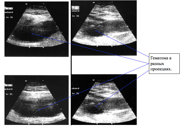 УЗИ гематомы мягких тканей бедра.