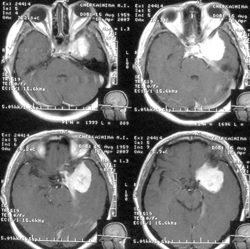 Рисунок 1. МРТ исследование головного мозга до операции.