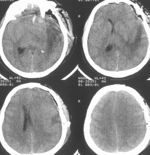 Рисунок 5. МРТ исследование головного мозга через 1,5 месяца после операции.